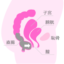 直腸瘤